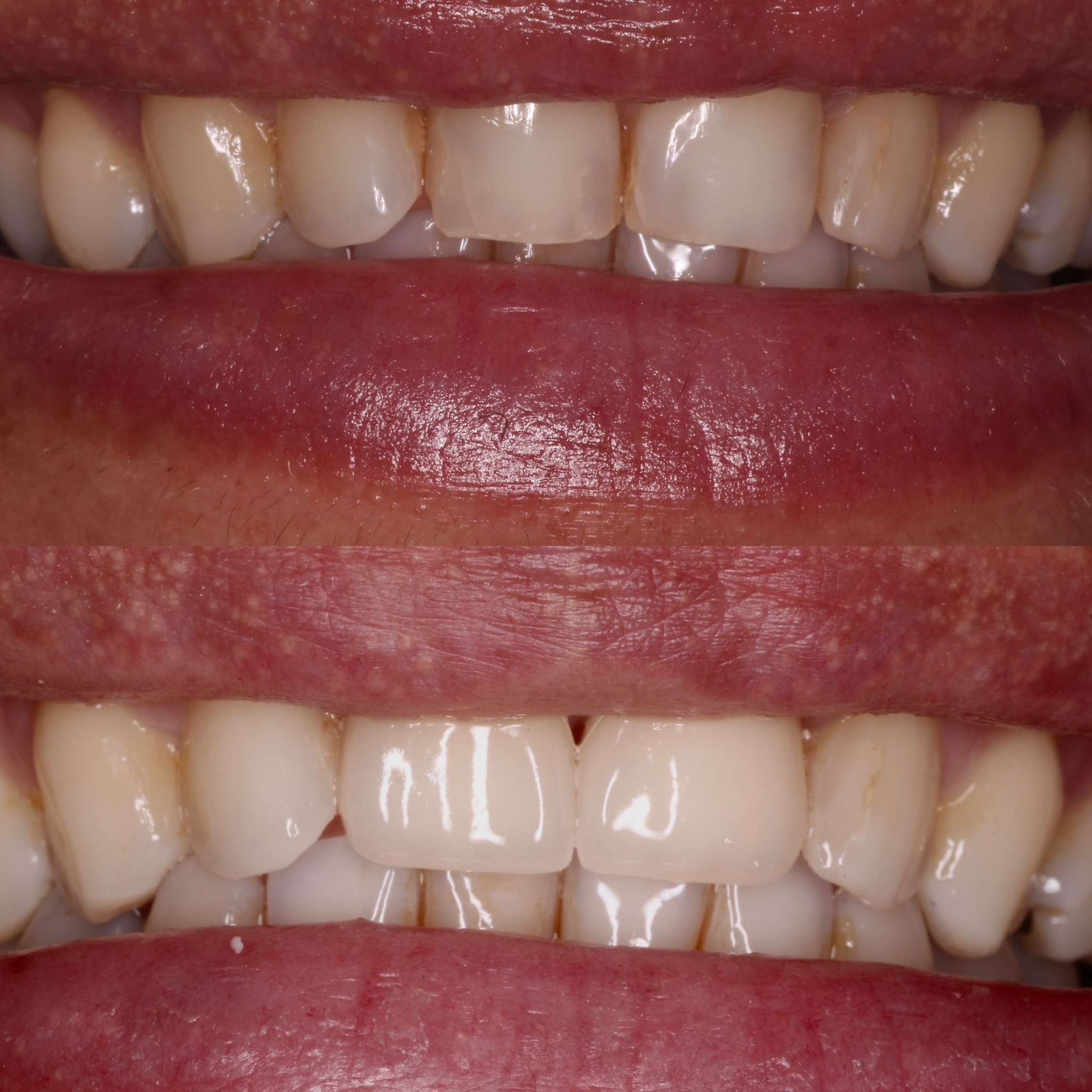 Close-up of dental treatment being done in Whittier dental office.