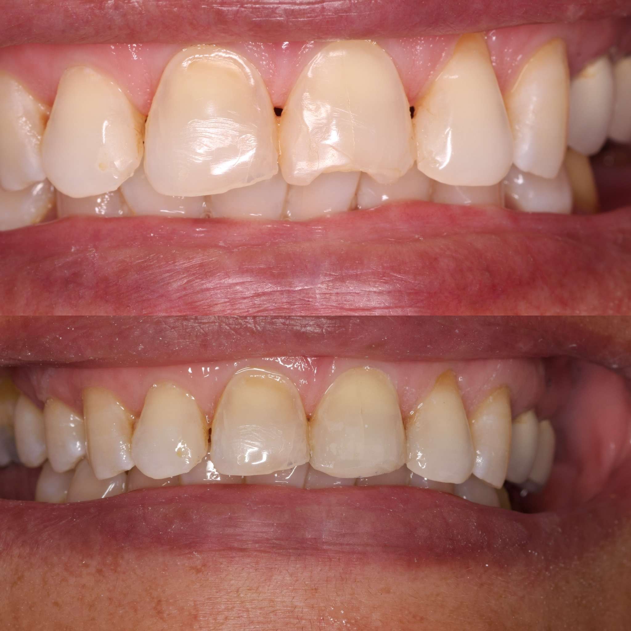 before and after dental treatment