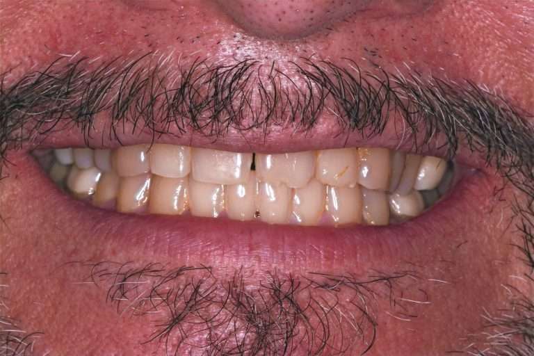 patient teeth smile