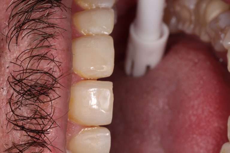 dental procedure